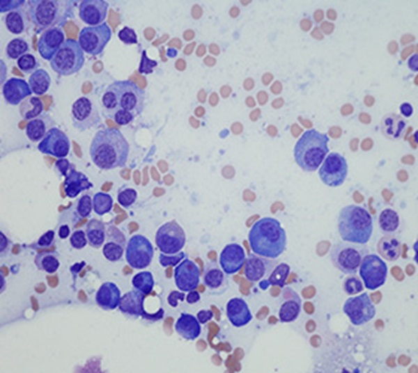 myelomatose-thumbnail